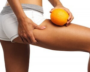 celluliteWhat-causes-cellulite-1024x682